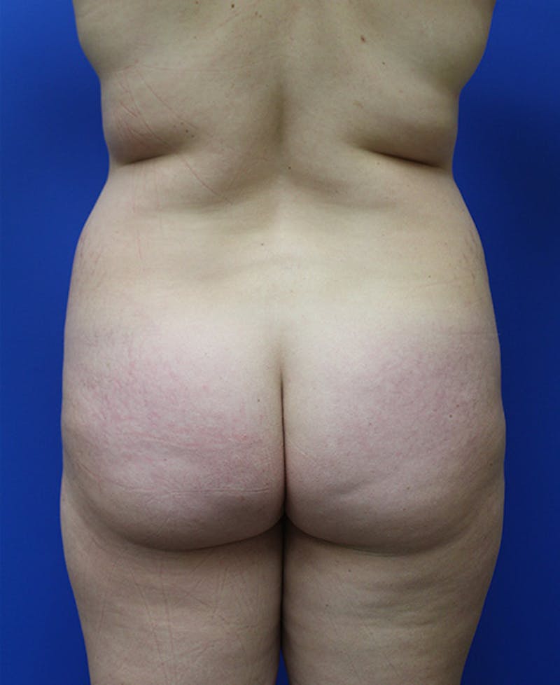 Mommy Makeover Before & After Gallery - Patient 315911 - Image 9