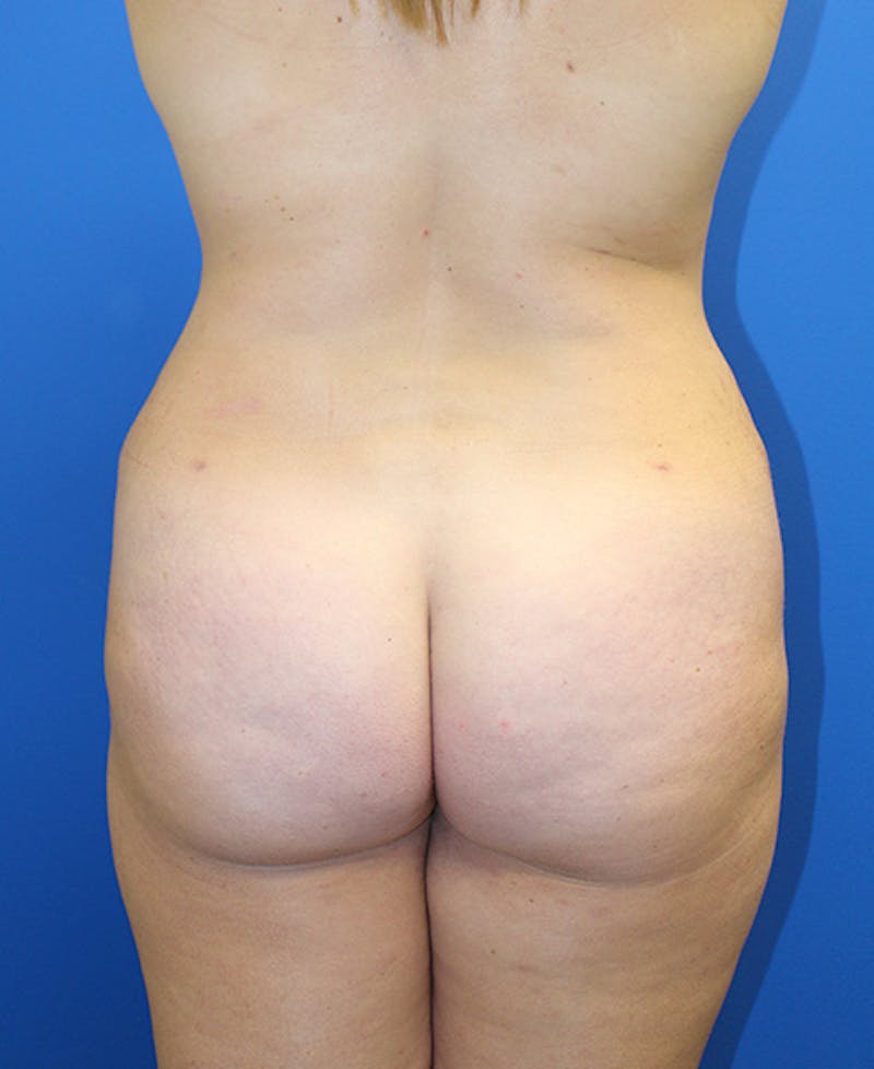 Mommy Makeover Before & After Gallery - Patient 315911 - Image 10