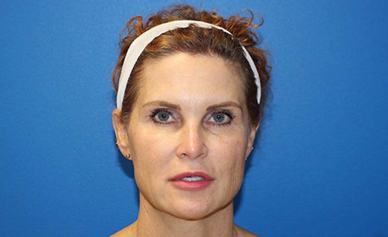 Halo Laser Before & After Gallery - Patient 402643 - Image 1