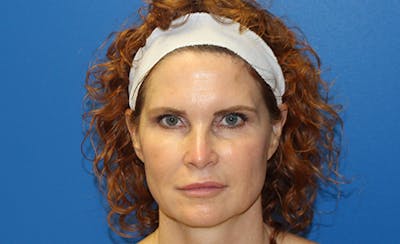Halo Laser Before & After Gallery - Patient 402643 - Image 2