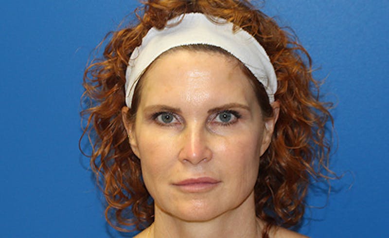 Halo Laser Before & After Gallery - Patient 402643 - Image 2