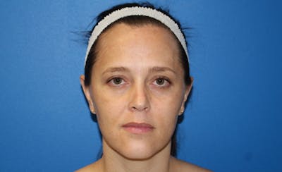 Halo Laser Before & After Gallery - Patient 883739 - Image 1