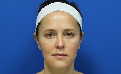 Halo Laser Before & After Gallery - Patient 883739 - Image 2