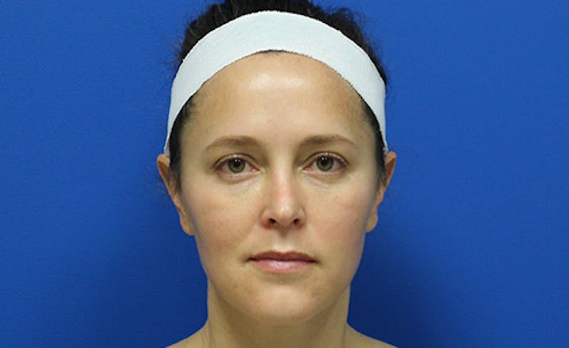 Halo Laser Before & After Gallery - Patient 883739 - Image 2