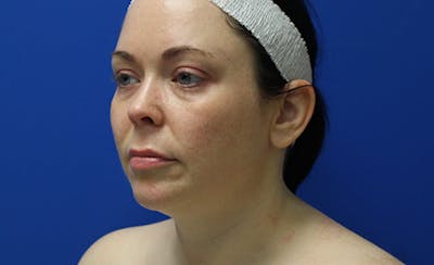 Halo Laser Before & After Gallery - Patient 294309 - Image 1