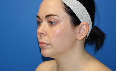 Halo Laser Before & After Gallery - Patient 294309 - Image 2