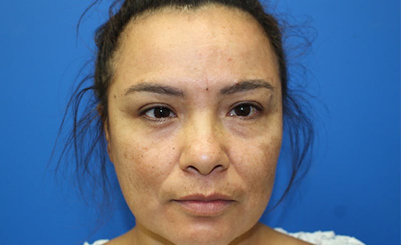 Halo Laser Before & After Gallery - Patient 341231 - Image 1