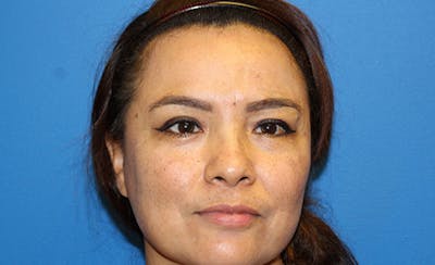 Halo Laser Before & After Gallery - Patient 341231 - Image 2