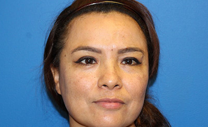 Halo Laser Before & After Gallery - Patient 341231 - Image 2