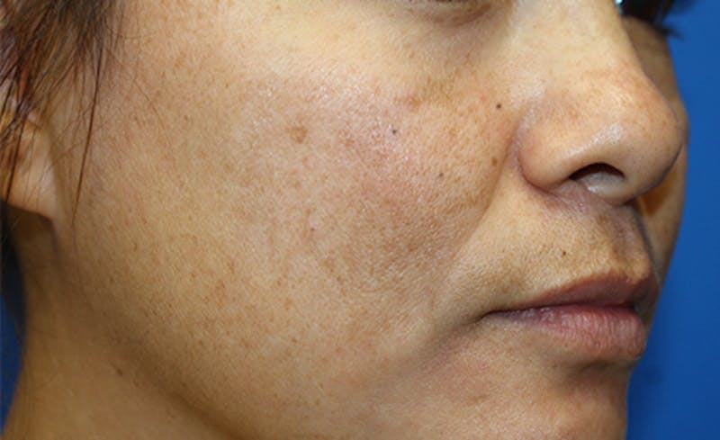 Halo Laser Before & After Gallery - Patient 341231 - Image 3