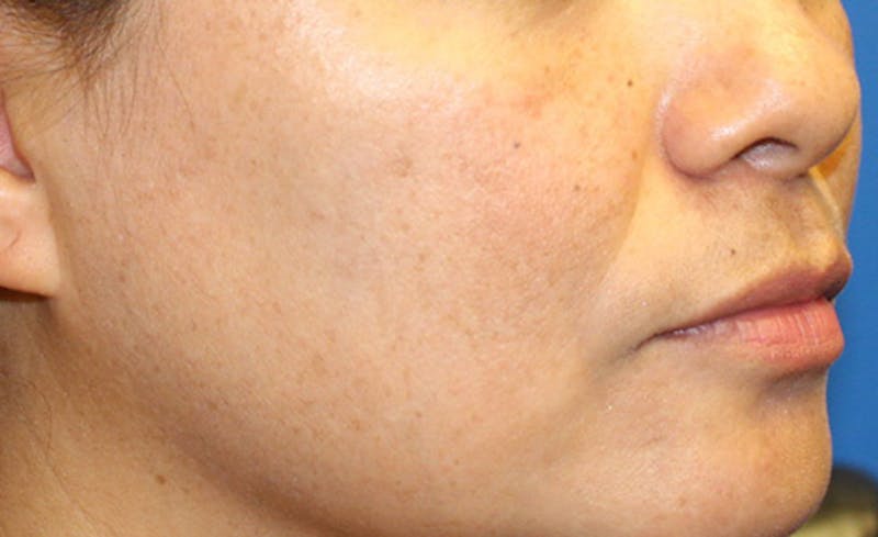 Halo Laser Before & After Gallery - Patient 341231 - Image 4