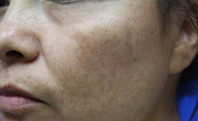 Halo Laser Before & After Gallery - Patient 341231 - Image 5