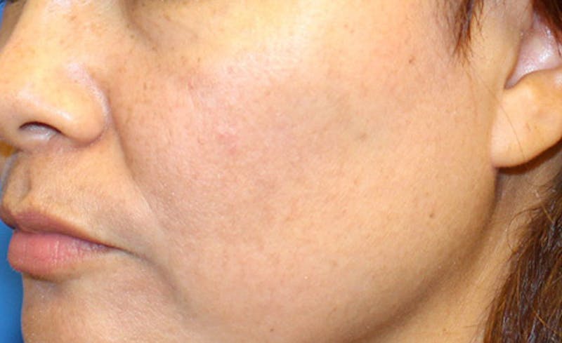 Halo Laser Before & After Gallery - Patient 341231 - Image 6