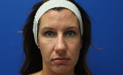 Halo Laser Before & After Gallery - Patient 848013 - Image 1