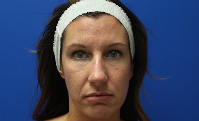 Halo Laser Before & After Gallery - Patient 848013 - Image 1