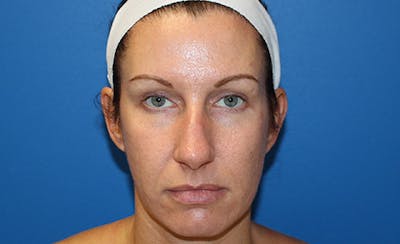 Halo Laser Before & After Gallery - Patient 848013 - Image 2