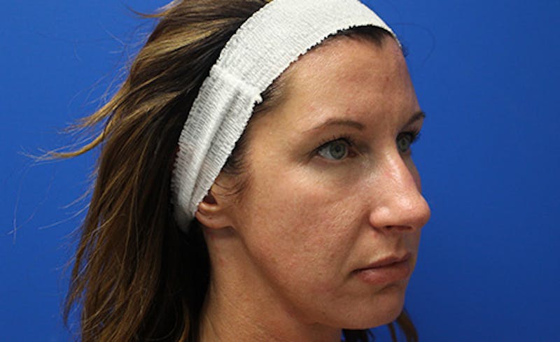 Halo Laser Before & After Gallery - Patient 848013 - Image 3