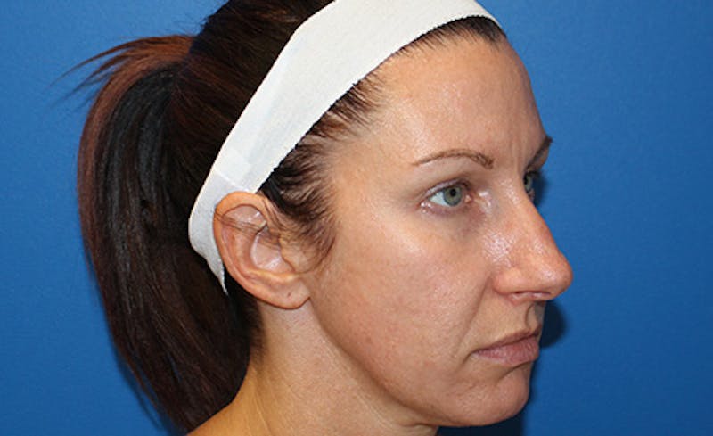 Halo Laser Before & After Gallery - Patient 848013 - Image 4