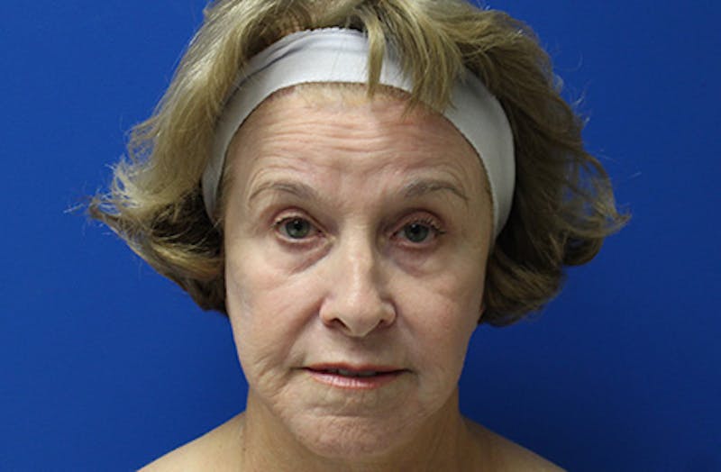 Halo Laser Before & After Gallery - Patient 403740 - Image 1