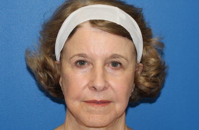 Halo Laser Before & After Gallery - Patient 403740 - Image 2