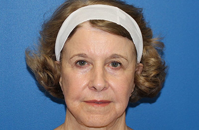 Halo Laser Before & After Gallery - Patient 403740 - Image 2