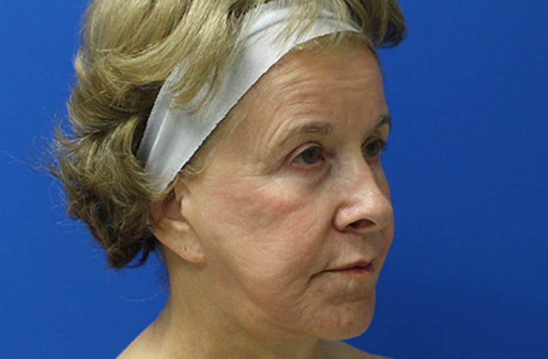 Halo Laser Before & After Gallery - Patient 403740 - Image 3