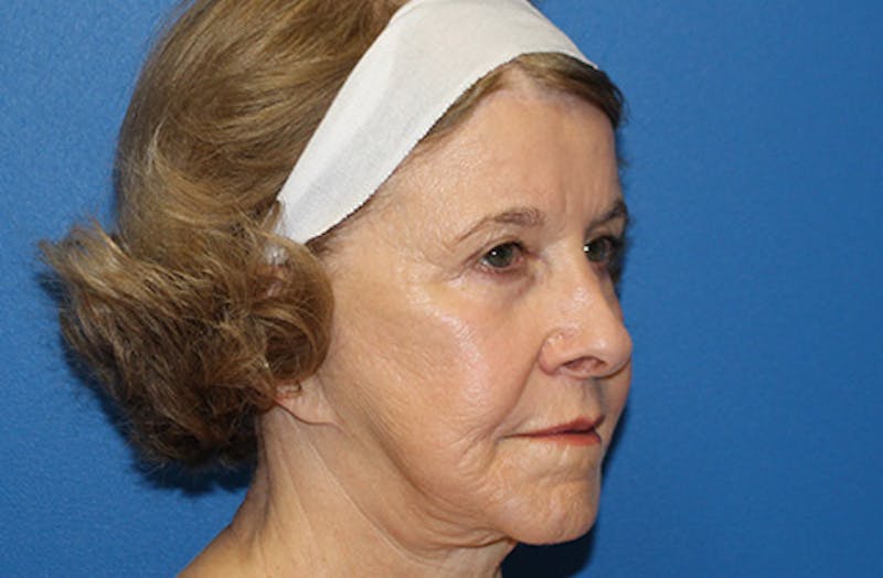 Halo Laser Before & After Gallery - Patient 403740 - Image 4