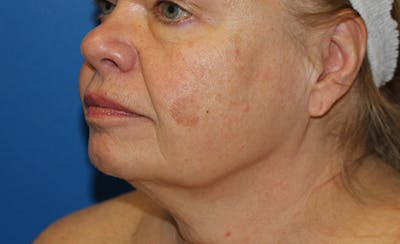 Halo BBL Before & After Gallery - Patient 380367 - Image 1