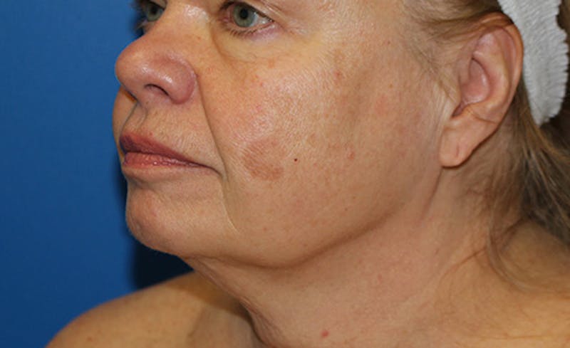 Halo BBL Before & After Gallery - Patient 380367 - Image 1