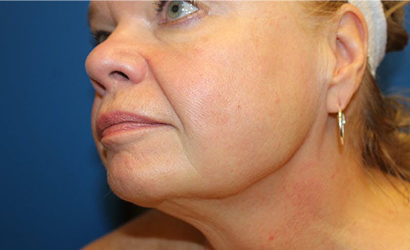 Halo BBL Before & After Gallery - Patient 380367 - Image 2