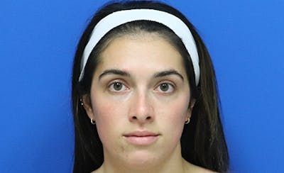 Halo BBL Before & After Gallery - Patient 190719 - Image 1