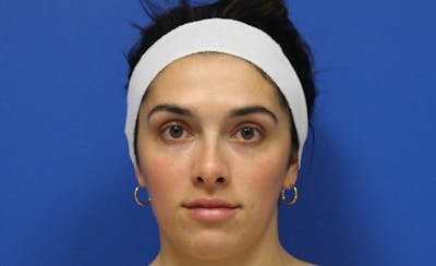 Halo BBL Before & After Gallery - Patient 190719 - Image 2