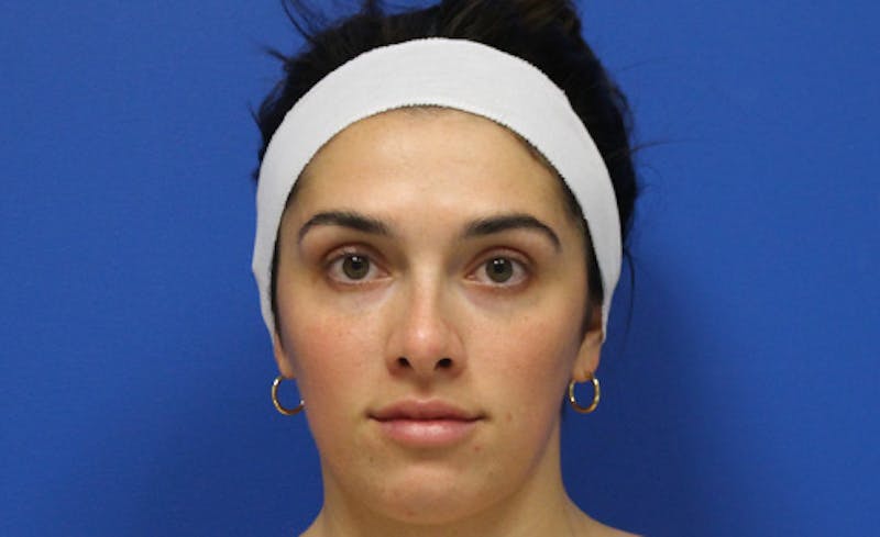 Halo BBL Before & After Gallery - Patient 190719 - Image 2