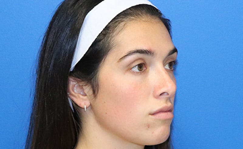Halo BBL Before & After Gallery - Patient 190719 - Image 3