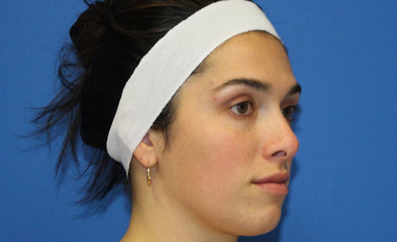 Halo BBL Before & After Gallery - Patient 190719 - Image 4