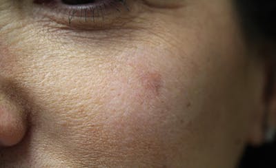 Halo BBL Before & After Gallery - Patient 213307 - Image 1