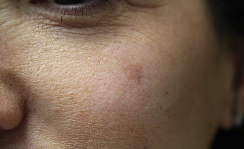 Halo BBL Before & After Gallery - Patient 213307 - Image 1