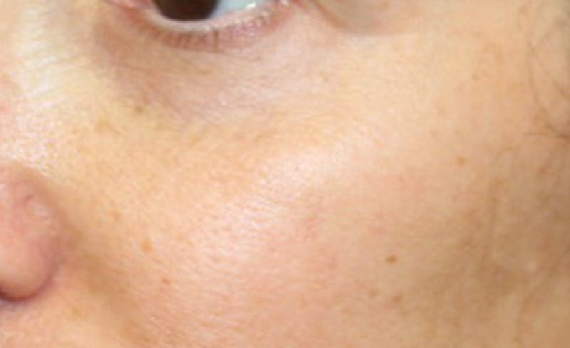 Halo BBL Before & After Gallery - Patient 213307 - Image 2