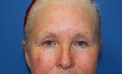 Laser Rosacea Before & After Gallery - Patient 198289 - Image 1