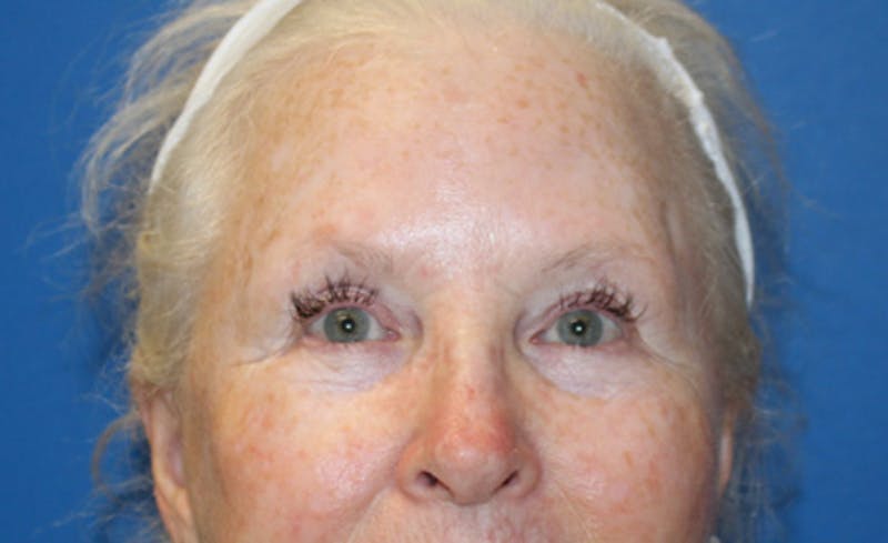 Laser Rosacea Before & After Gallery - Patient 198289 - Image 2
