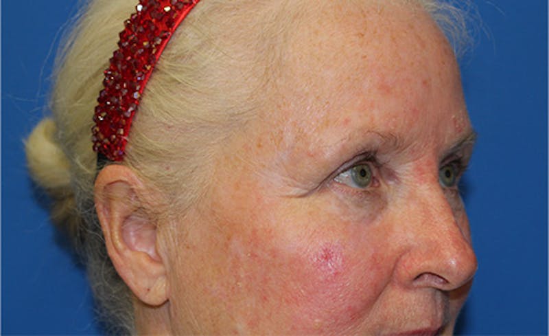 Laser Rosacea Before & After Gallery - Patient 198289 - Image 3