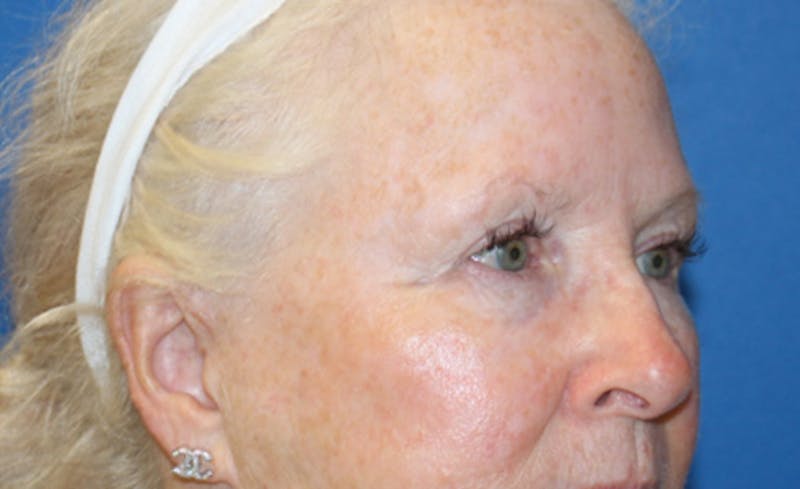 Laser Rosacea Before & After Gallery - Patient 198289 - Image 4
