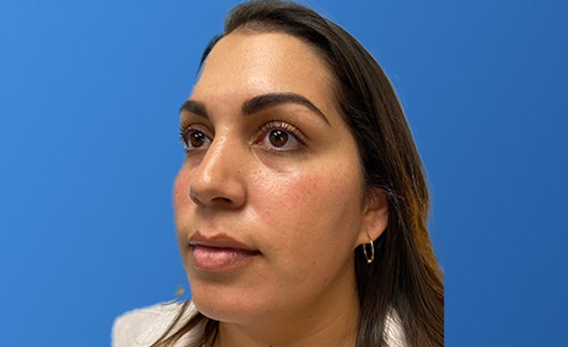 Facial Fillers Before & After Gallery - Patient 966866 - Image 1