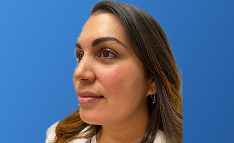 Facial Fillers Before & After Gallery - Patient 966866 - Image 2