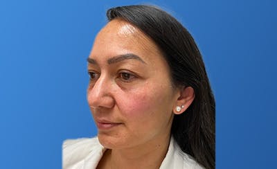 Facial Fillers Before & After Gallery - Patient 222600 - Image 1