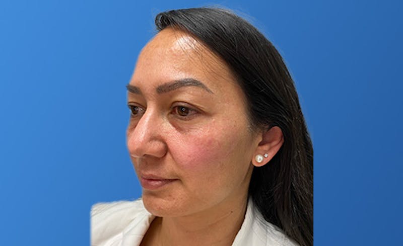 Facial Fillers Before & After Gallery - Patient 222600 - Image 1