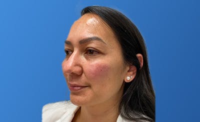 Facial Fillers Before & After Gallery - Patient 222600 - Image 2
