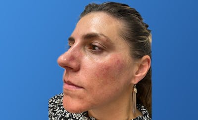 Facial Fillers Before & After Gallery - Patient 155064 - Image 1