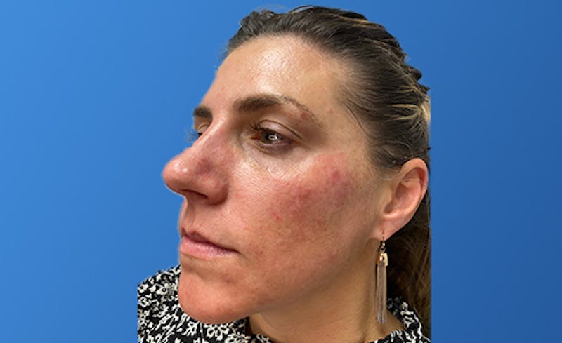 Facial Fillers Before & After Gallery - Patient 155064 - Image 1