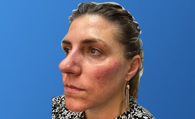 Facial Fillers Before & After Gallery - Patient 155064 - Image 2
